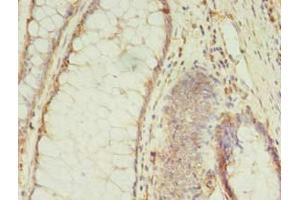 Immunohistochemistry of paraffin-embedded human colon cancer using ABIN7159399 at dilution of 1:100 (MS4A7 抗体  (AA 1-47))