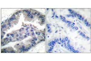 Immunohistochemical analysis of paraffin-embedded human lung carcinoma tissue, using BIK (Phospho-Thr33) antibody. (BIK 抗体  (pThr33))