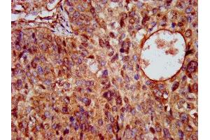 IHC image of ABIN7163983 diluted at 1:200 and staining in paraffin-embedded human cervical cancer performed on a Leica BondTM system. (Kcne3 抗体  (AA 1-57))