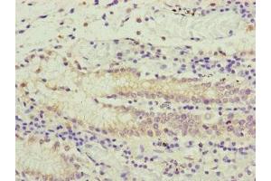 Immunohistochemistry of paraffin-embedded human gastric cancer using ABIN7166519 at dilution of 1:100 (PCDHA12 抗体  (AA 862-941))