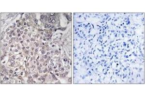 Immunohistochemistry analysis of paraffin-embedded human liver carcinoma, using Cytochrome P450 4F2 Antibody. (CYP4F2 抗体  (AA 41-90))
