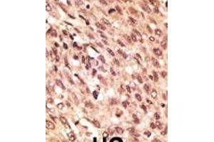 Formalin-fixed and paraffin-embedded human cancer tissue reacted with the primary antibody, which was peroxidase-conjugated to the secondary antibody, followed by AEC staining. (LRP5 抗体  (C-Term))