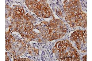 Immunoperoxidase of monoclonal antibody to EIF4G3 on formalin-fixed paraffin-embedded human lung, adenosquamous cell carcinoma. (EIF4G3 抗体  (AA 1-515))