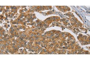 Immunohistochemistry of paraffin-embedded Human breast cancer tissue using ERK 3 Polyclonal Antibody at dilution 1:40 (MAPK6 抗体)