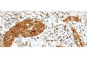 Immunohistochemistry of paraffin-embedded Human esophagus cancer tissue using HMG20A Polyclonal Antibody at dilution of 1:25(x200) (HMG20A 抗体)