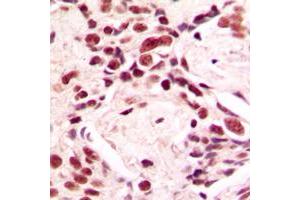 Immunohistochemical analysis of Lamin A/C staining in human breast cancer formalin fixed paraffin embedded tissue section. (Lamin A/C 抗体  (Center))