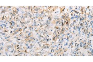 Immunohistochemistry of paraffin-embedded Human gasrtic cancer tissue using NPPC Polyclonal Antibody at dilution 1:70 (NPPC 抗体)