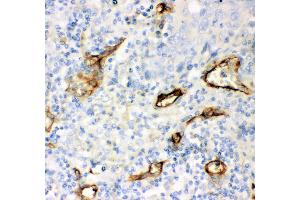 Anti- CD146 antibody, IHC(P) IHC(P): Human Lung Cancer Tissue (MCAM 抗体  (AA 59-401))