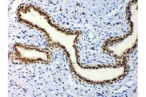 IHC analysis of ETV6/Tel using anti-ETV6/Tel antibody . (ETV6 抗体  (AA 327-448))