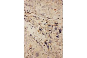 Anti-RANK antibody, IHC(P) IHC(P): Human Mammary Cancer Tissue (TNFRSF11A 抗体  (N-Term))