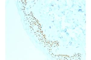 Formalin-fixed, paraffin-embedded human Basal Cell Carcinoma stained with p63 Mouse Monoclonal Antibody (TP63/2428).