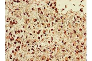 IHC image of ABIN7173856 diluted at 1:400 and staining in paraffin-embedded human glioma performed on a Leica BondTM system. (NGFR 抗体  (AA 277-391))