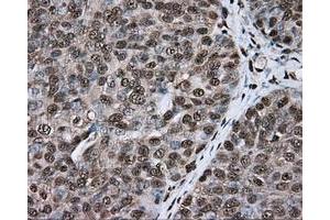 Immunohistochemical staining of paraffin-embedded colon tissue using anti-ERCC1 mouse monoclonal antibody. (ERCC1 抗体)
