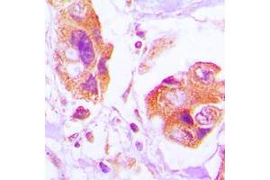 Immunohistochemical analysis of Filamin A (pS2152) staining in human lung cancer formalin fixed paraffin embedded tissue section. (Filamin A 抗体  (C-Term, pSer2152))