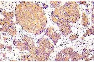 Immunohistochemistry (IHC) analyzes of p-COFILN1 (pSer3) antibody in paraffin-embedded human lung adenocarcinoma tissue. (Cofilin 抗体  (pSer3))