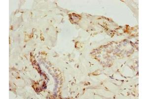 Immunohistochemistry of paraffin-embedded human breast cancer using ABIN7176183 at dilution of 1:100 (ZNF232 抗体  (AA 1-417))