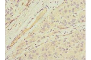 Immunohistochemistry of paraffin-embedded human liver cancer using ABIN7143763 at dilution of 1:100 (MGAT1 抗体  (AA 156-445))