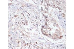 Immunohistochemistry of paraffin-embedded Human lung cancer using Phospho-Jak2(Y1007/1008) Polyclonal Antibody at dilution of 1:200 (40x lens). (JAK2 抗体  (pTyr1007, pTyr1008))