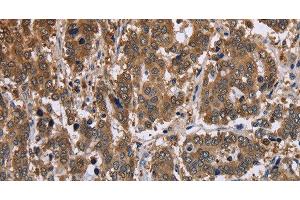 Immunohistochemistry of paraffin-embedded Human liver cancer tissue using FBP2 Polyclonal Antibody at dilution 1:40 (FBP2 抗体)