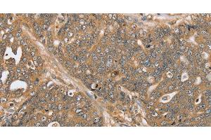 Immunohistochemistry of paraffin-embedded Human ovarian cancer using PTPN20 Polyclonal Antibody at dilution of 1:30 (PTPN20 抗体)