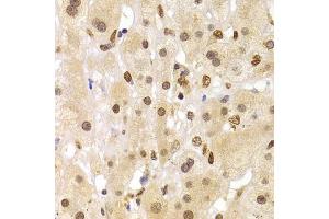 Immunohistochemistry of paraffin-embedded human liver cancer using HNRNPA1 Antibody (ABIN5975570) at dilution of 1/100 (40x lens). (HNRNPA1 抗体)