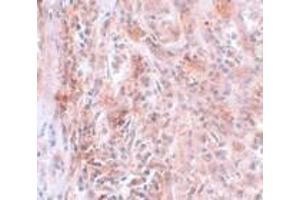 Immunohistochemistry of BCAS2 in human breast carcinoma with BCAS2 antibody at 5 μg/ml. (BCAS2 抗体  (C-Term))