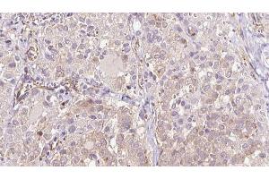 ABIN6273315 at 1/100 staining Human thyroid cancer tissue by IHC-P. (SEC63 抗体  (C-Term))