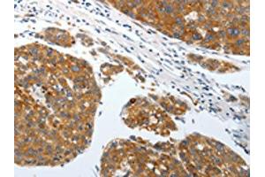 The image on the left is immunohistochemistry of paraffin-embedded Human liver cancer tissue using ABIN7192428(SLC22A3 Antibody) at dilution 1/25, on the right is treated with synthetic peptide. (SLC22A3 抗体)