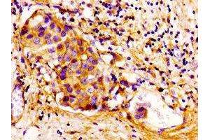 Immunohistochemistry of paraffin-embedded human breast cancer using ABIN7148919 at dilution of 1:100 (CDKN3 抗体  (AA 1-172))
