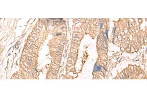 Immunohistochemistry of paraffin-embedded Human colorectal cancer tissue using IL24 Polyclonal Antibody at dilution of 1:30(x200) (IL-24 抗体)