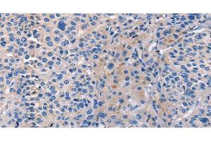 Immunohistochemistry of paraffin-embedded Human liver cancer tissue using CD5L Polyclonal Antibody at dilution 1:40 (CD5L 抗体)