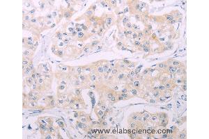 Immunohistochemistry of Human breast cancer using ADCY7 Polyclonal Antibody at dilution of 1:60 (ADCY7 抗体)