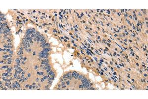 Immunohistochemistry of paraffin-embedded Human colon cancer tissue using BAIAP2 Polyclonal Antibody at dilution 1:50 (BAIAP2 抗体)