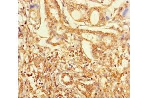 Immunohistochemistry of paraffin-embedded human pancreatic cancer using ABIN7176457 at dilution of 1:100 (ZNF627 抗体  (AA 1-300))