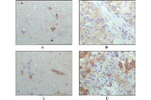 Immunohistochemical analysis of paraffin-embedded human brain hippocampus (A), lung cancer (B), brain tumor (C), breast cance (D), showing cytoplasmic localization with DAB staining using CRYAB mouse mAb. (CRYAB 抗体  (AA 1-175))