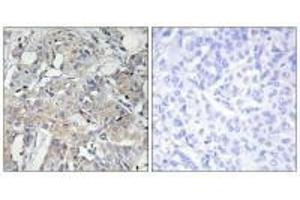 Immunohistochemistry analysis of paraffin-embedded human breast carcinoma tissue using Collagen VI α3 antibody. (COL6a3 抗体)