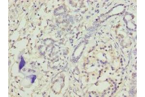 Immunohistochemistry of paraffin-embedded human pancreatic cancer using ABIN7172914 at dilution of 1:100 (TRAM2 抗体  (AA 316-370))