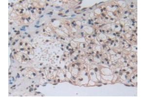 IHC-P analysis of Human Kidney Cancer Tissue, with DAB staining. (beta-Thromboglobulin 抗体  (AA 59-128))