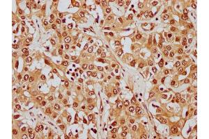 IHC image of nphHU diluted at 1:8 and staining in paraffin-embedded human liver cancer performed on a Leica BondTM system. (HIST1H1E 抗体  (AA 21-33))