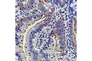 Immunohistochemical analysis of Ribophorin-1 staining in human colon cancer formalin fixed paraffin embedded tissue section. (RPN1 抗体)