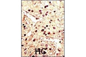 Formalin-fixed and paraffin-embedded human cancer tissue reacted with the primary antibody, which was peroxidase-conjugated to the secondary antibody, followed by DAB staining. (Aurora-B (ARK/STK12) (AA 6-35), (N-Term) 抗体)