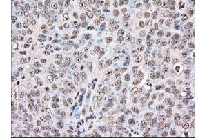 Immunohistochemical staining of paraffin-embedded Adenocarcinoma of Human colon tissue using anti-BAT1 mouse monoclonal antibody. (BAT1 抗体)