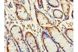 Immunohistochemistry of paraffin-embedded human gastric cancer using ABIN7166961 at dilution of 1:100 (RABGAP1L 抗体  (Isoform 10))