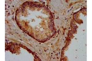 IHC image of ABIN7157575 diluted at 1:400 and staining in paraffin-embedded human prostate cancer performed on a Leica BondTM system. (KIFAP3 抗体  (AA 660-792))