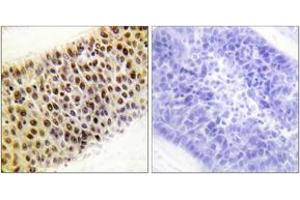 Immunohistochemistry analysis of paraffin-embedded human liver carcinoma tissue, using TIP60 (Ab-86) Antibody. (KAT5 抗体  (AA 52-101))