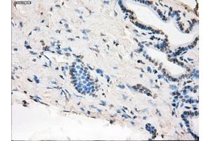 Immunohistochemical staining of paraffin-embedded Adenocarcinoma of colon tissue using anti-MAP2K1 mouse monoclonal antibody. (MEK1 抗体)