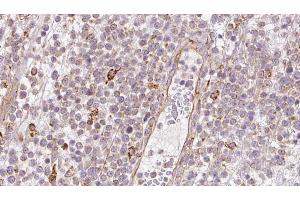 ABIN6273202 at 1/100 staining Human lymph cancer tissue by IHC-P. (BBS4 抗体  (Internal Region))