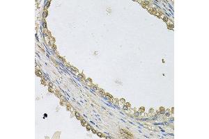 Immunohistochemistry of paraffin-embedded human prostate using MTERFD1 antibody at dilution of 1:100 (x40 lens). (MTERFD1 抗体)