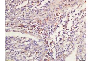 paraformaldehyde-fixed, paraffin embedded human laryngocarcinoma tissue; Antigen retrieval with 0. (GNLY 抗体  (AA 23-120))