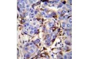 Immunohistochemistry analysis in formalin fixed and paraffin embedded human breast carcinoma reacted PIP / GCDFP15 Antibody (C-term) followed by peroxidase conjugation of the secondary antibody and DAB staining. (PIP 抗体  (C-Term))